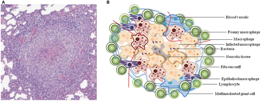 Tuberkulosis (TB)