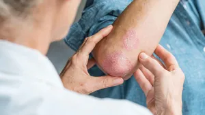 Psoriasis: Penyakit Autoimun yang Menyerang Kulit
