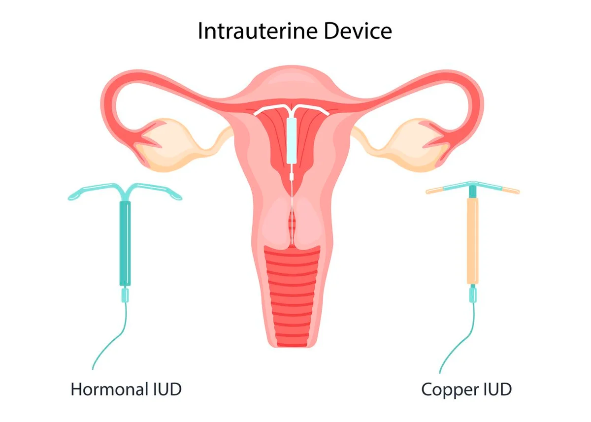 IUD Hormonal dan Non Hormonal, Apa Bedanya?