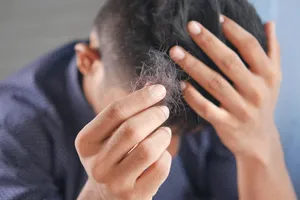 Konsumsi Minuman Manis Dapat Menyebabkan Kebotakan pada Pria?