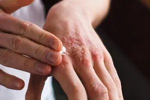 Jangan Asal Oles Salep, Begini Cara Mengontrol Eksim!