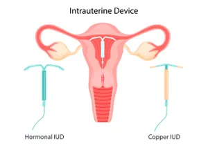 IUD Hormonal dan Non Hormonal, Apa Bedanya?