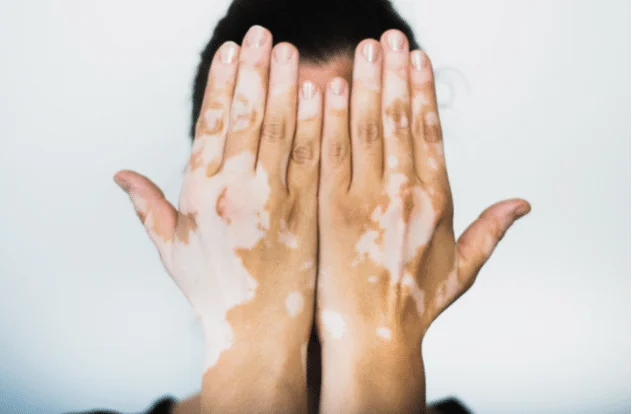 Mitos dan Fakta Tentang Vitiligo: Menghilangkan Stigma dengan Meningkatkan Pemahaman
